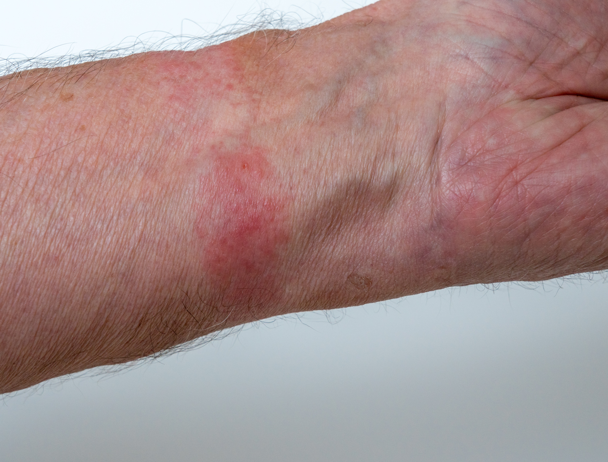 Dermatite de contacto nas mãos, causada pelo uso de um relógio: Getty Images Dermatite de contacto nas mãos