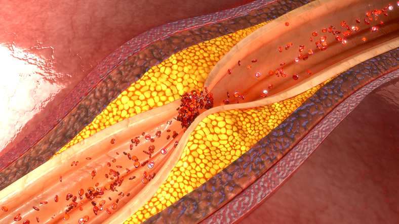 PA devido a aterosclerose das artérias coronárias: Getty Images Angina de peito e aterosclerose e placa aterosclerótica no vaso coronário ou cardíaco