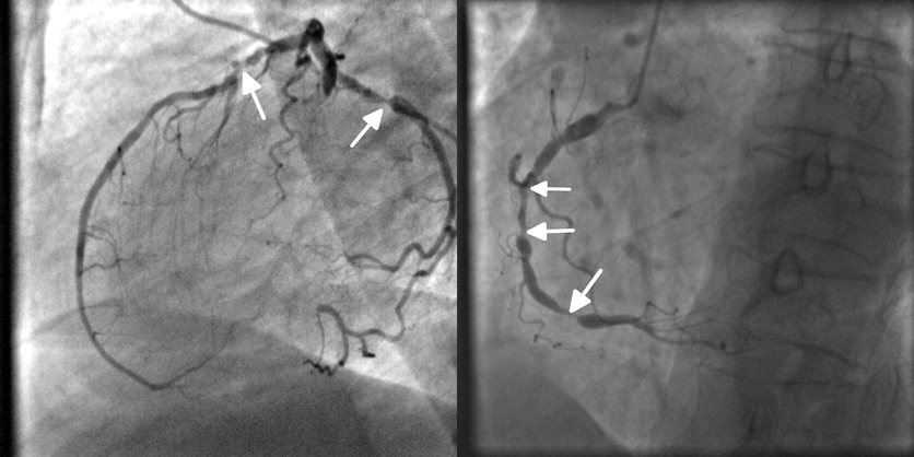 A coronariografia mostra o estado das artérias do coração. Foto de origem: Getty Images Coronariografia, angiografia, bloqueio das artérias coronárias