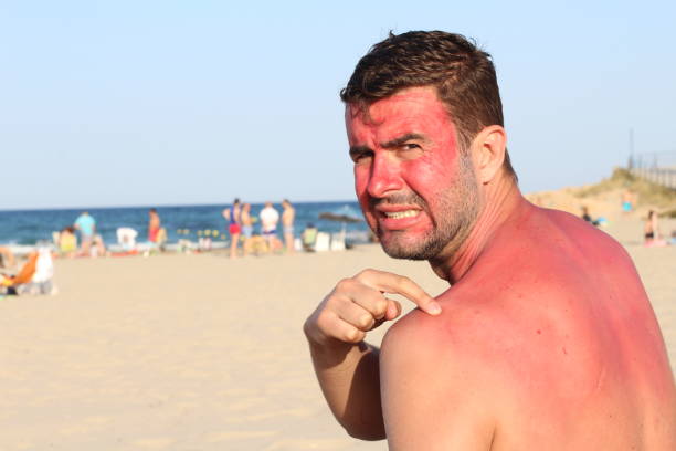 A pele queimada pelo sol é uma predisposição para os tumores cutâneos