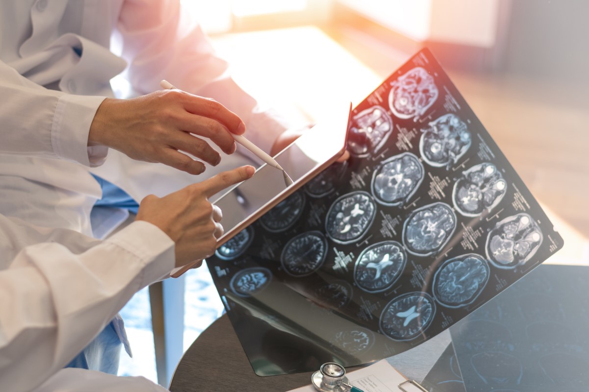 A tarefa do diagnóstico consiste também em distinguir a esclerose múltipla de outra doença, ou seja, o diagnóstico diferencial: Getty Images A ecografia cerebral, como base do exame, o médico segura as imagens numa mão, na outra segura um tablet, avalia o estado.