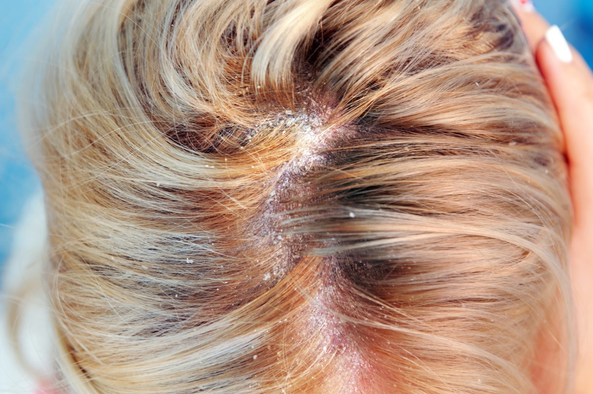 Escamas, caspa no cabelo na seborreia Fonte: Getty Images Seborreia nos cabelos de uma mulher, caspa na dermatite seborreica
