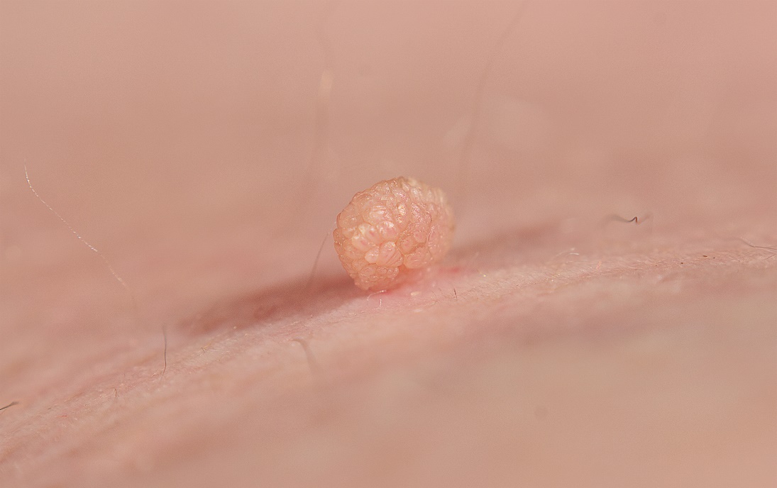 Fibroma de pele mole (fibroma molle) Fonte da foto: Getty Images Fibroma de pele mole (fibroma molle)