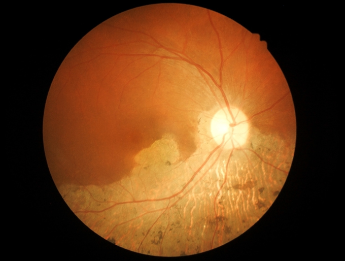 O que um oftalmologista vê na degenerescência macular. Foto: Thinkstock Degenerescência macular ao exame oftalmológico