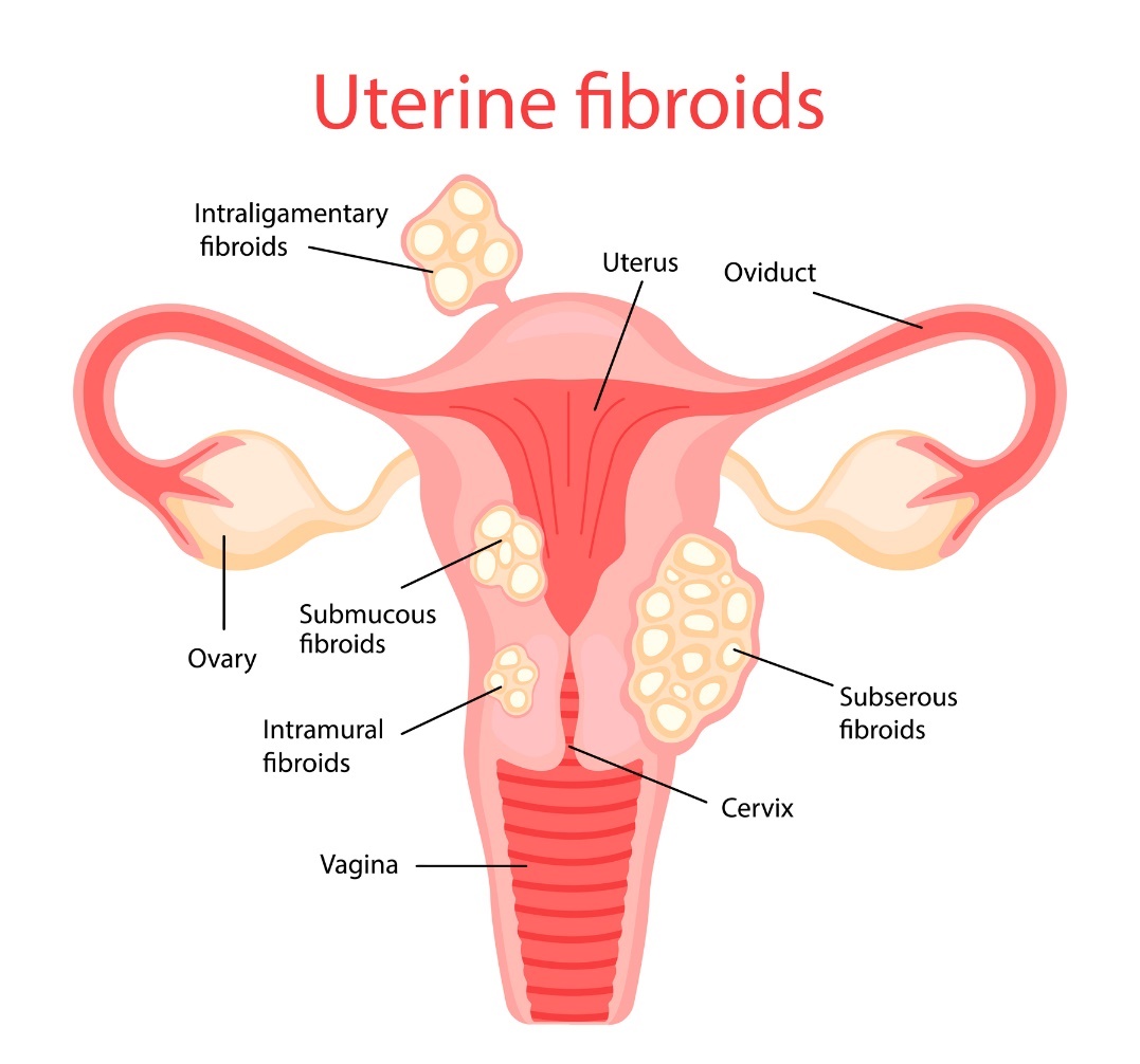 miomas uterinos: miomas pedunculados, miomas submucosos, miomas intramucosos e miomas subserosos Anatomia: Útero (uterus), Oviduto (trompa de Falópio), Ovário (ovary), Cérvix (cervix), vagina Fonte: Getty Images miomas uterinos