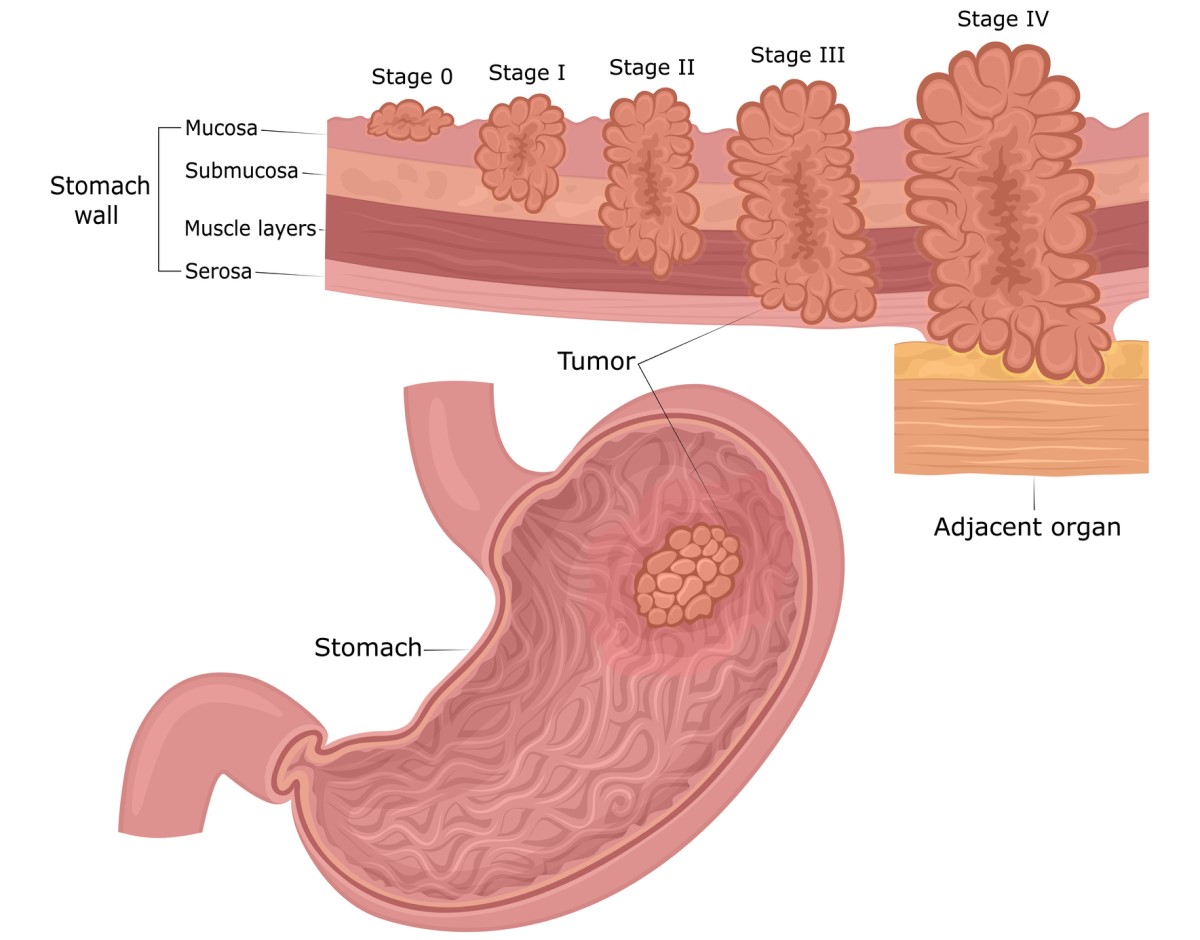 Cancro gástrico: as camadas da parede gástrica (mucosa, submucosa, muscular, serosa) e as fases de desenvolvimento do tumor, desde a mucosa até aos arredores e aos órgãos: Getty Images Cancro gástrico: as camadas da parede do estômago (mucosa, submucosa, músculo, serosa) e as fases de desenvolvimento do tumor, desde a mucosa até à periferia e aos órgãos.