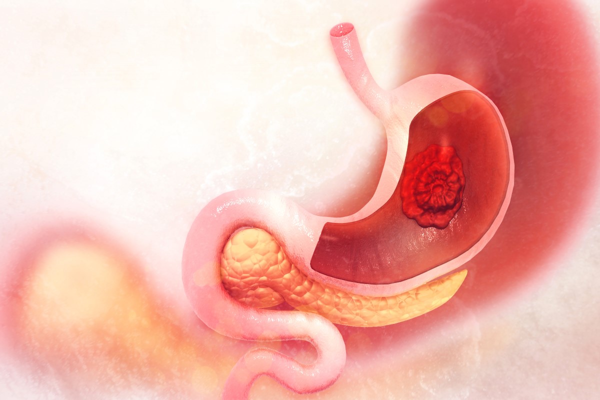 Visualização de um tumor maligno localizado no estômago. Fonte: Getty Images Visualização de um tumor maligno localizado no estômago.