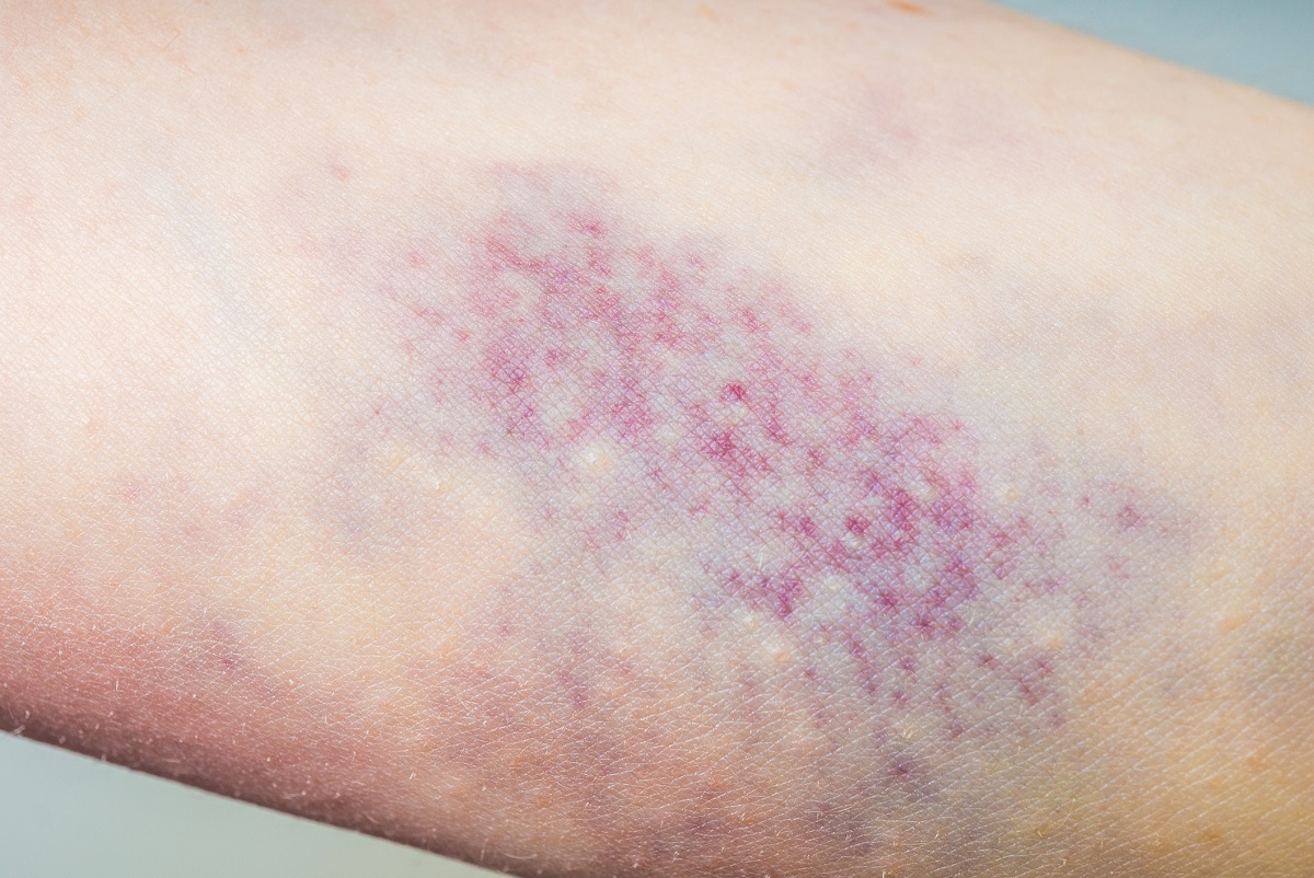 A doença hepática perturba a coagulação do sangue, que se manifesta por hematomas rápidos e hemorragias no tecido subcutâneo: Getty Images Formação de nódoas negras, petéquias