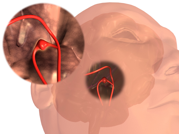Aneurisma da artéria cerebral. Fonte da foto: Getty Images Aneurisma de um vaso sanguíneo cerebral
