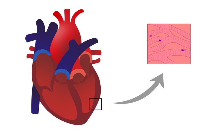 Miocardite: processo inflamatório com infiltração e degeneração de cardiomiócitos na parede muscular do coração: Getty Images Miocardite: processo inflamatório com infiltração e degeneração de cardiomiócitos na parede do músculo cardíaco.
