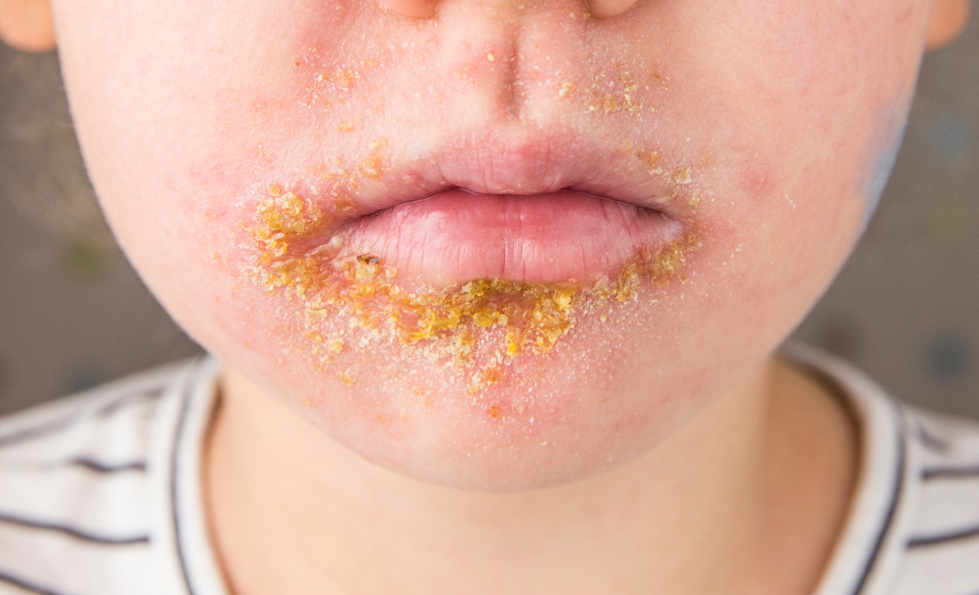 Impetigo nebuloso num rapaz de 5 anos
