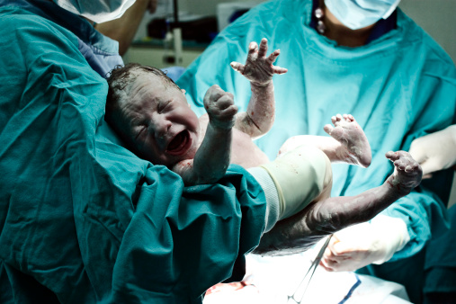 Infeção pós-parto: Getty Images Um recém-nascido a chorar nas mãos de um médico logo após a secção