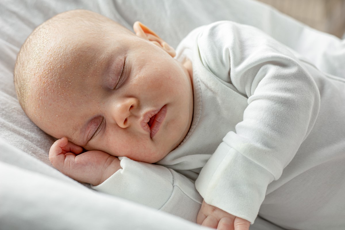 Afecta principalmente as crianças durante as primeiras 4 semanas a 3 meses de vida: Getty Images Uma criança pequena, recém-nascida, a dormir, com seborreia e escamas na cabeça.