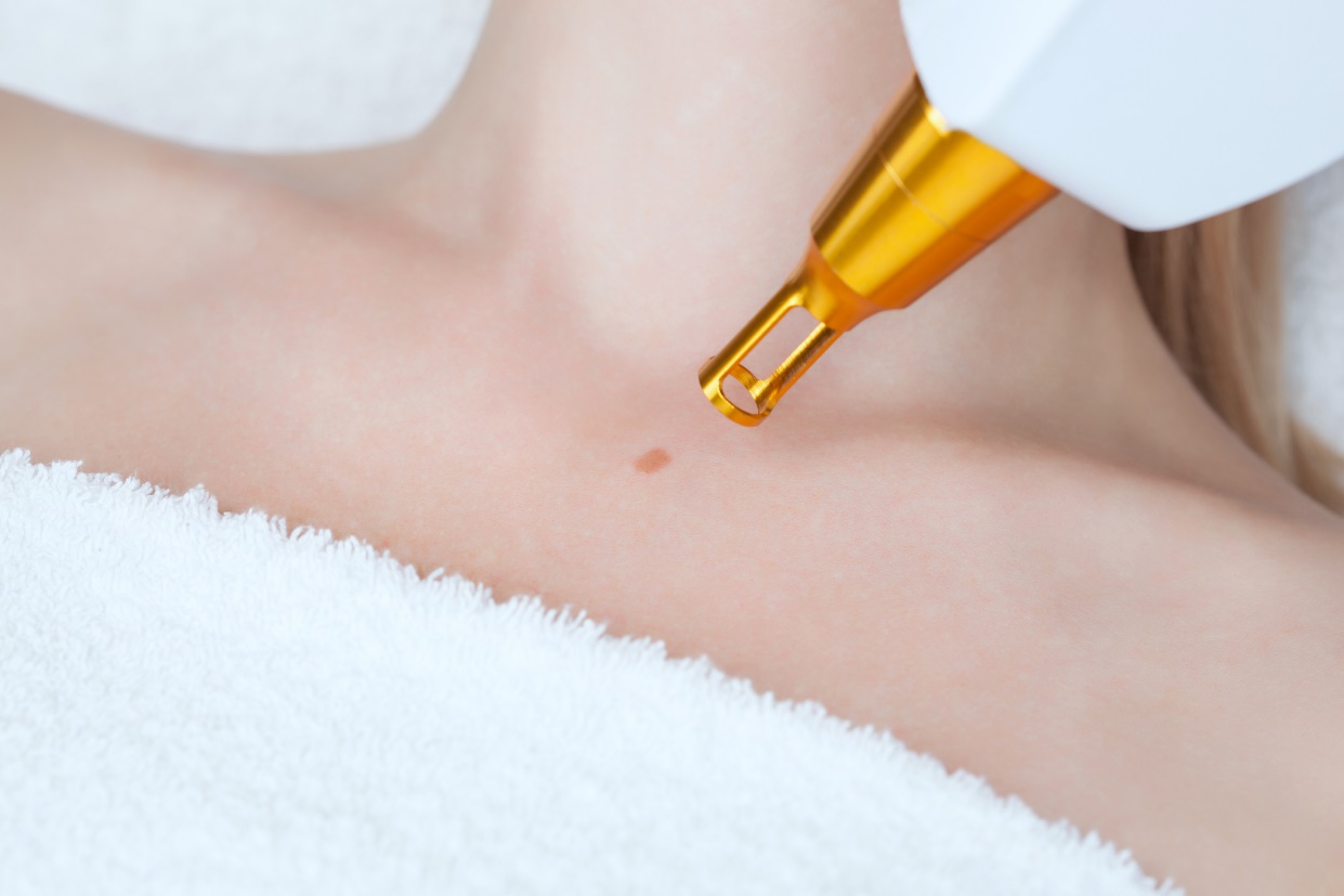 Tratamento e remoção de fibroma cutâneo com laser. Fonte da foto: Getty Images Tratamento e remoção de fibroma cutâneo com laser
