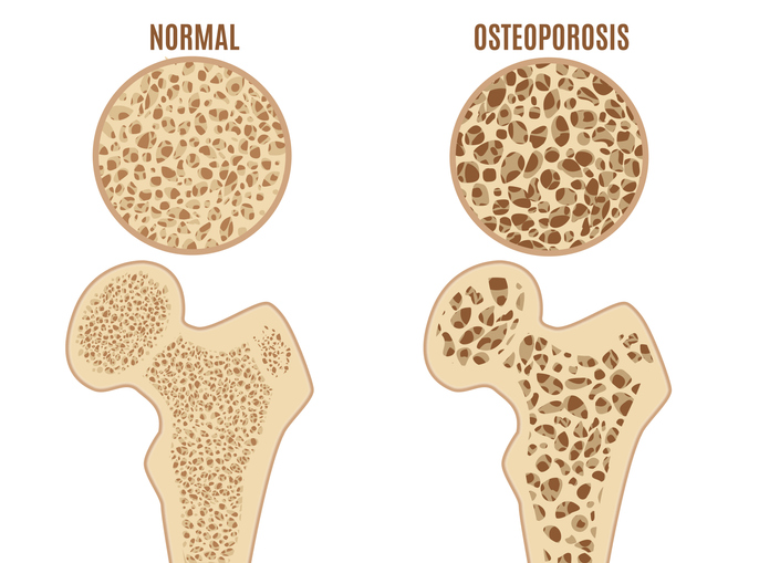 Osteoporose do fémur, fonte: Getty Images Osteoporose do fémur