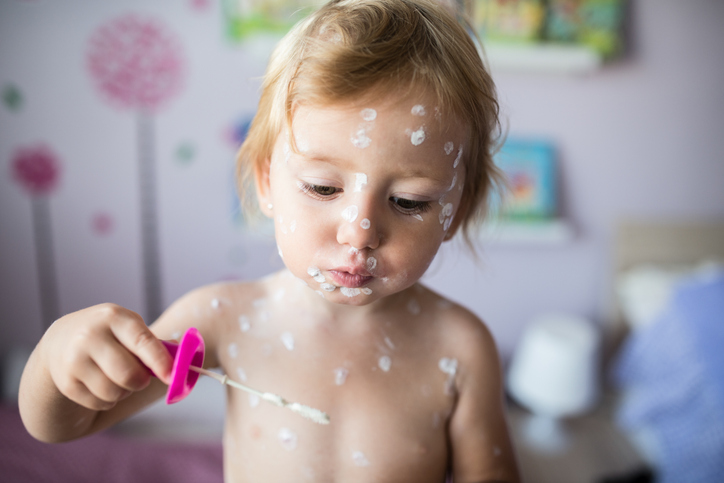 Em crianças com menos de 10 anos de idade, é habitual um curso ligeiro. Fonte da foto: Getty Images Uma menina com um caso ligeiro de varicela - brinca com um soprador de bolas de sabão