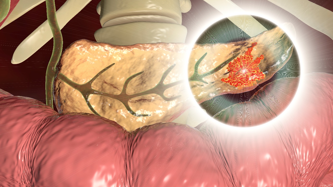 Pancreatite - lesão do pâncreas Fonte: Getty Images Pancreatite - parte infetada do pâncreas - cauda do pâncreas, vista anatómica