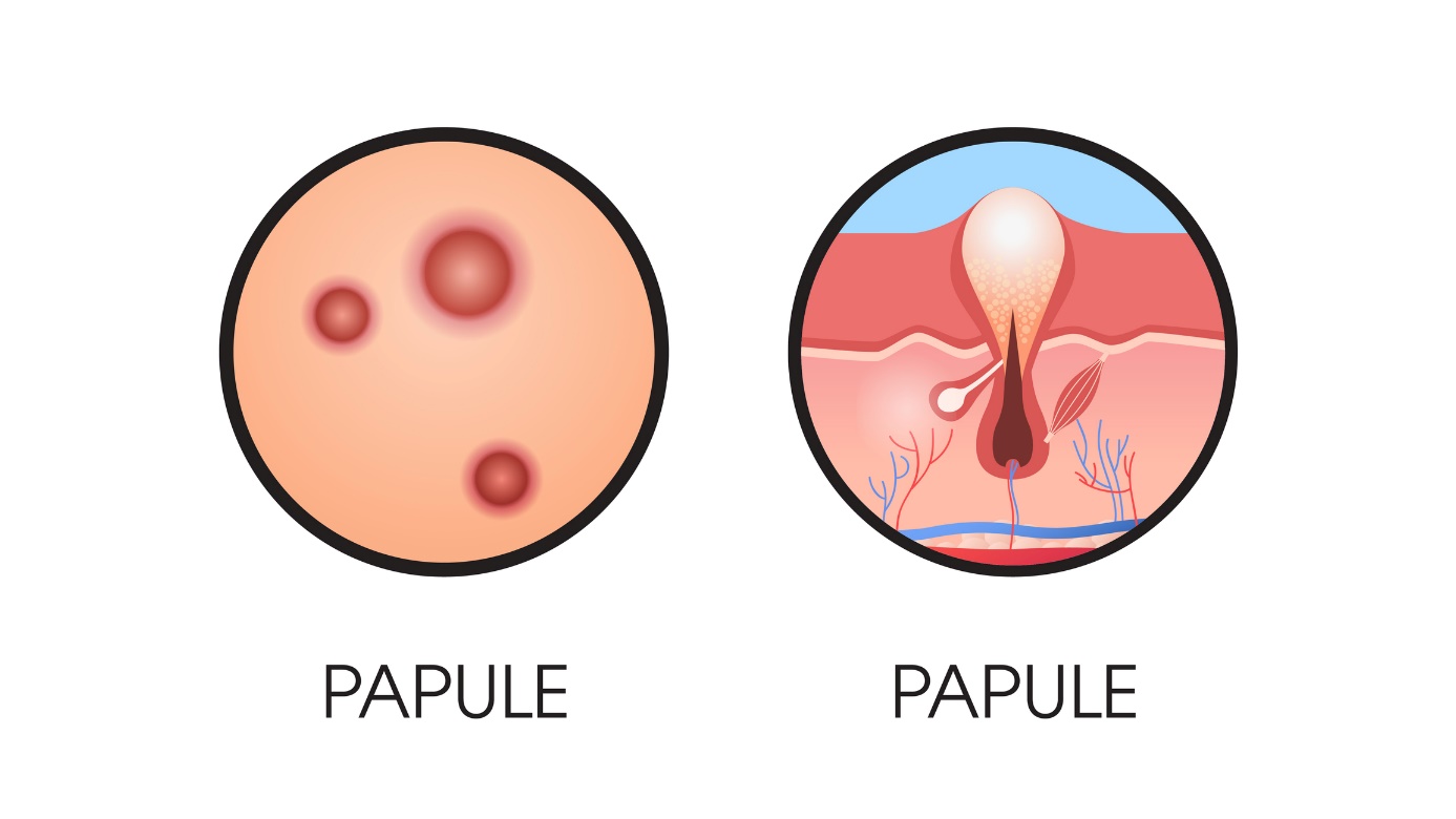 Ilustração do aspeto de uma pápula na pele Fonte: Getty Images pápula na pele