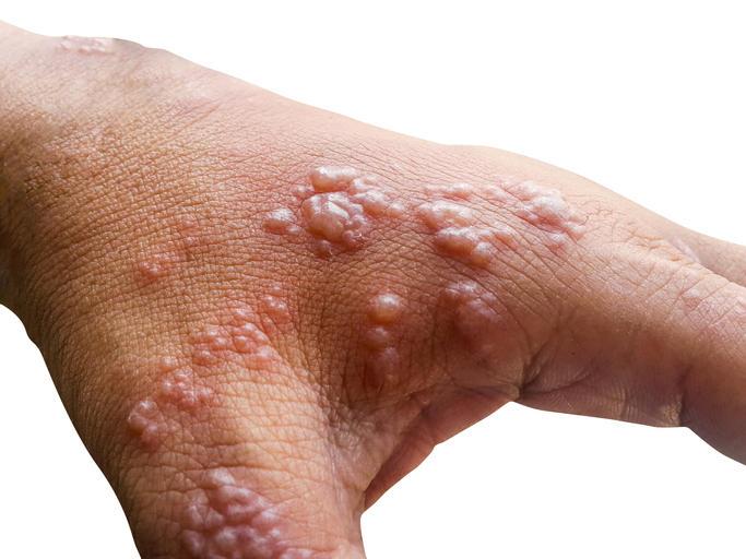 O diagnóstico é confirmado pela história clínica e pelos sintomas típicos da doença - herpes zoster na mão. Fonte da foto: Getty Images Zósteres na mão