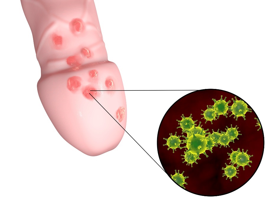 Formação de pequenas bolhas de herpes genital na zona genital do órgão masculino: Getty Images A formação de pequenas bolhas de herpes genital na zona genital do órgão masculino.
