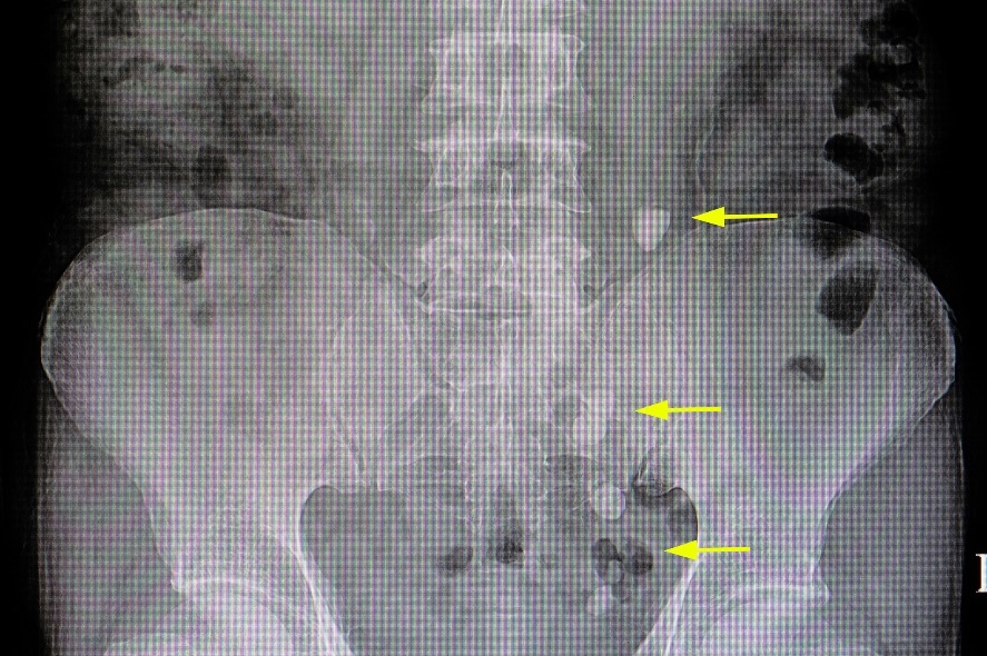 Radiografia: numerosos concrementos no trajecto das vias urinárias
