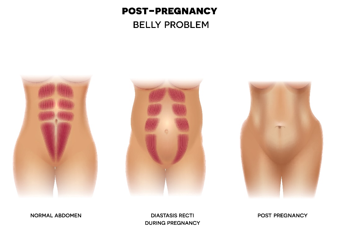 Diástase pós-parto da parede abdominal (estado fisiológico dos músculos abdominais, diástase durante a gravidez e estado pós-parto da parede abdominal): Getty Images Diástase pós-parto da parede abdominal