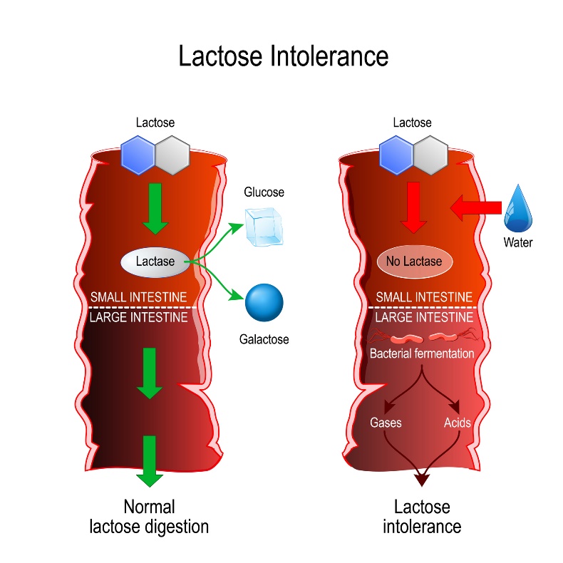 Comparação entre a digestão fisiológica e a intolerância à lactose. Lactose clivada pela enzima lactase em glucose e galactose // Lactose não clivada e subsequente formação de bactérias, ácidos e gases: Getty Images Comparação entre a digestão fisiológica e a intolerância à lactose