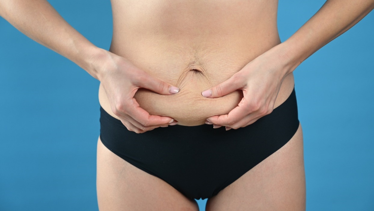 Parede abdominal solta e excesso de pele na diástase. Fonte da foto: Getty Images Parede abdominal solta e excesso de pele na diástase