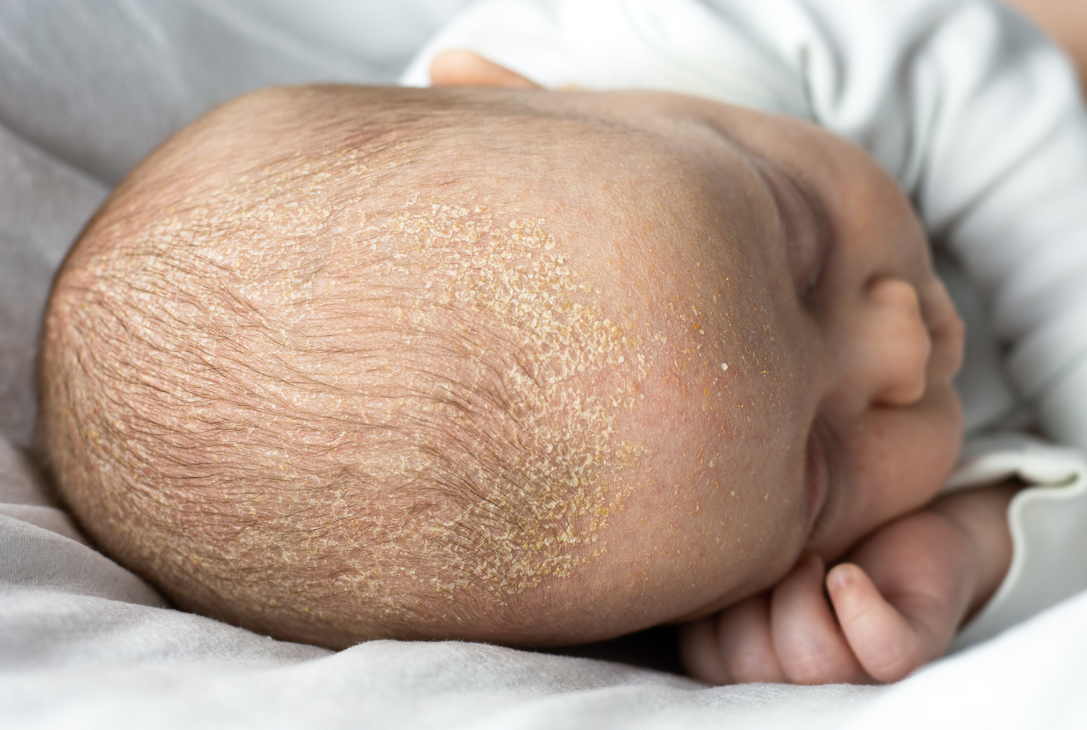 Escamas na cabeça de uma criança, uma manifestação de dermatite seborreica: Getty Images Manifestações da dermatite seborreica