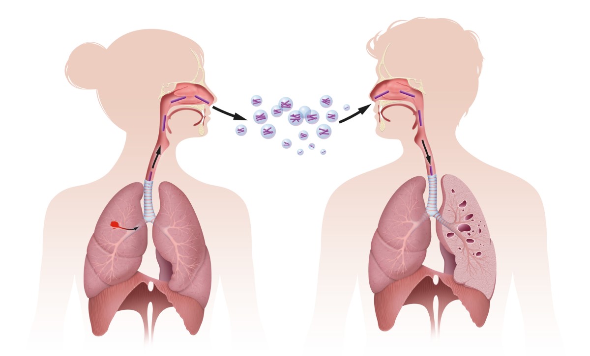 Bactérias facilmente transmissíveis, por exemplo, por inalação, inalação - infeção por gotículas Fonte: Getty Images Transmissão da TB por inalação, ou seja, por inalação, a figura mostra a transmissão por inalação.