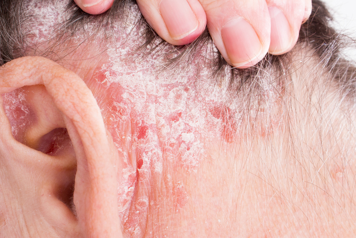 Escamas na psoríase ou psoríase Fonte: Getty Images Psoríase ou psoríase no couro cabeludo atrás das orelhas e no cabelo