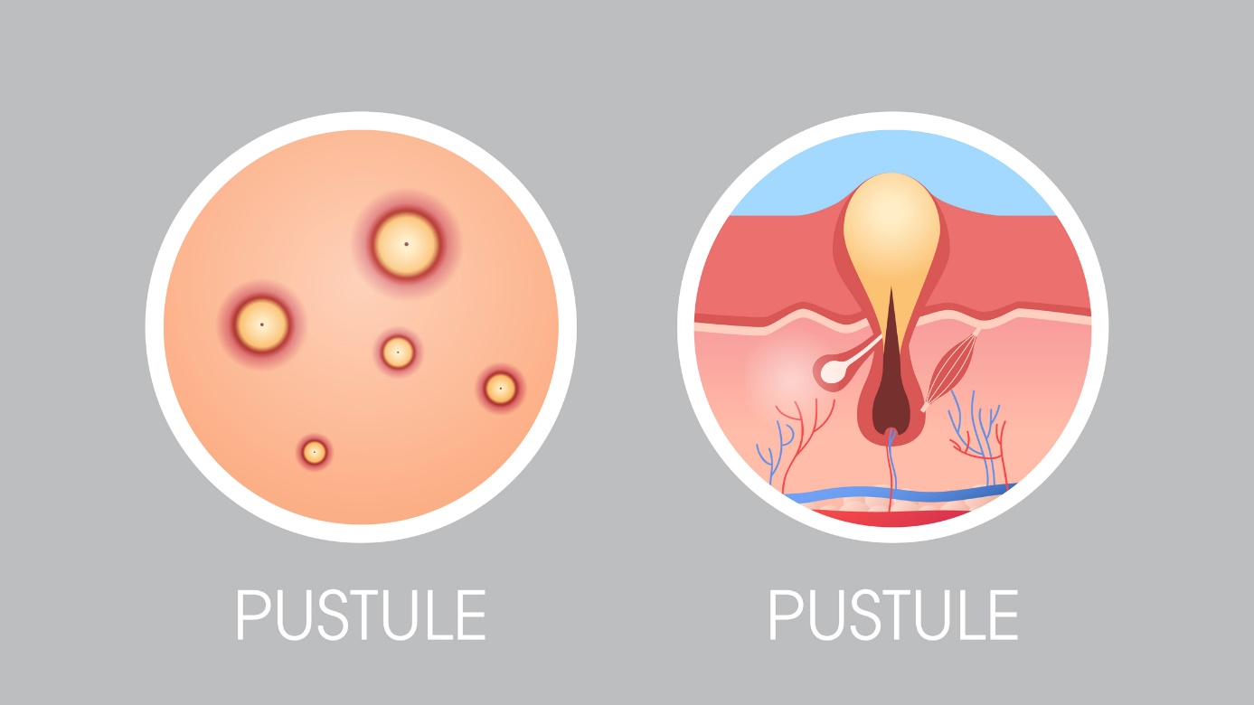 Ilustração do aspeto de uma pústula na pele e da forma como se forma: Getty Images Qual o aspeto de uma bolha na pele e como se forma.