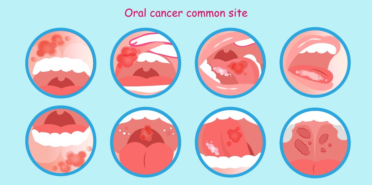 Cancro oral e locais do tumor Fonte: Getty Images Cancro oral e depósitos tumorais - um modelo