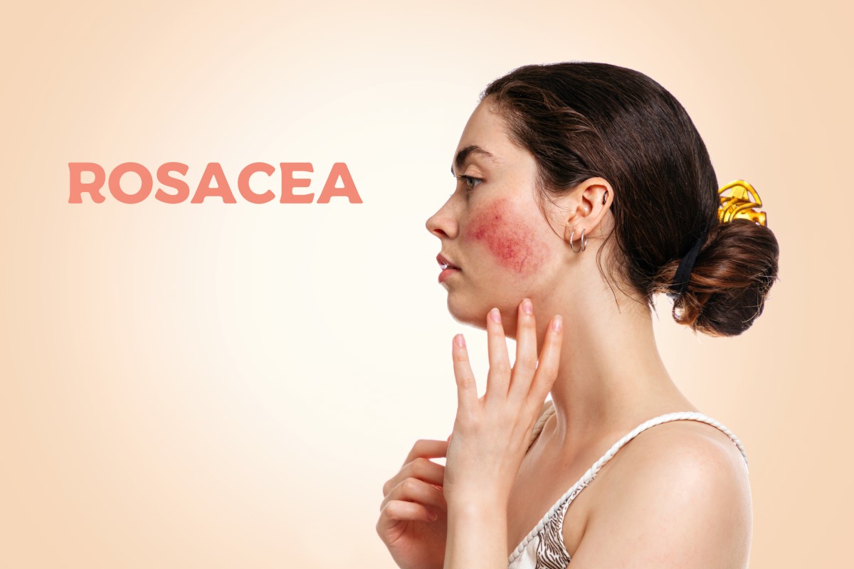Rosácea e a sua manifestação típica - vermelhidão da zona facial. Fonte da fotografia: Getty Images Mulher de lado, rosto com rosácea - rosácea