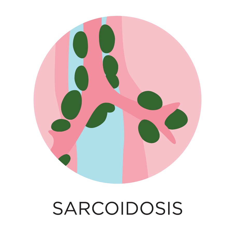 Sarcoidose - formação de granulomas