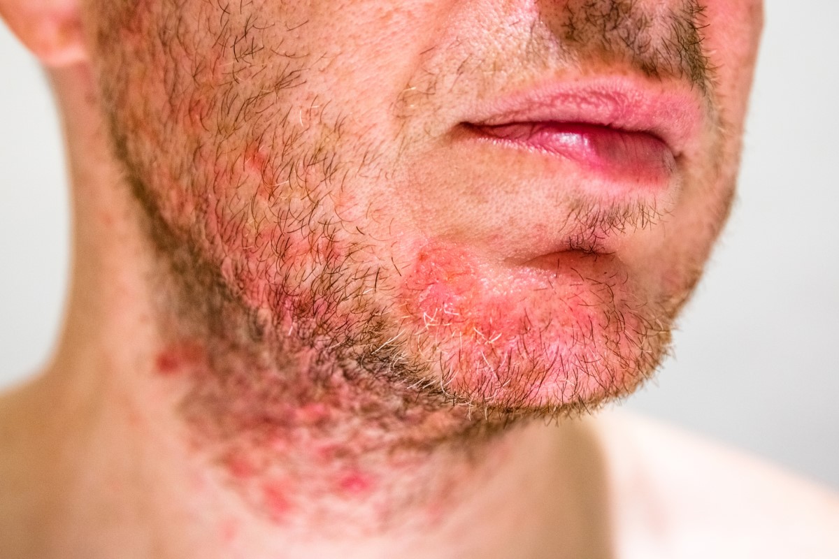 Na idade adulta, aparecem manchas oleosas ou secas. A cor dos depósitos é avermelhada com escamas esbranquiçadas descamativas: Getty Images Homem com seborreia no queixo, rosto vermelho com sinais de dermatite