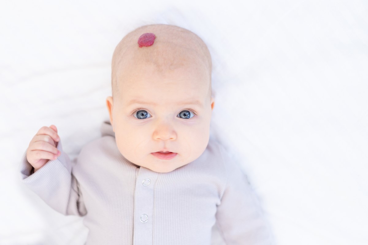 Encontram-se frequentemente na cabeça e na parte peluda: Getty Images Hemangioma na cabeça de uma criança - uma ocorrência comum