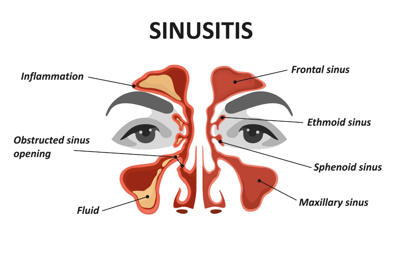 Modelo/imagem animada de sinusite e sinusite