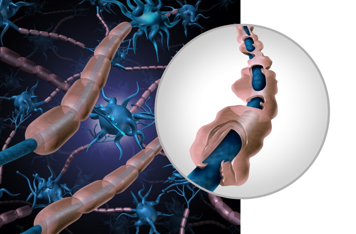 Ilustração de um neurónio saudável e de um neurónio danificado - uma fibra desmielinizada: Getty Images Representação anatómica e pictórica de neurónio saudável e danificado - fibra desmielinizada