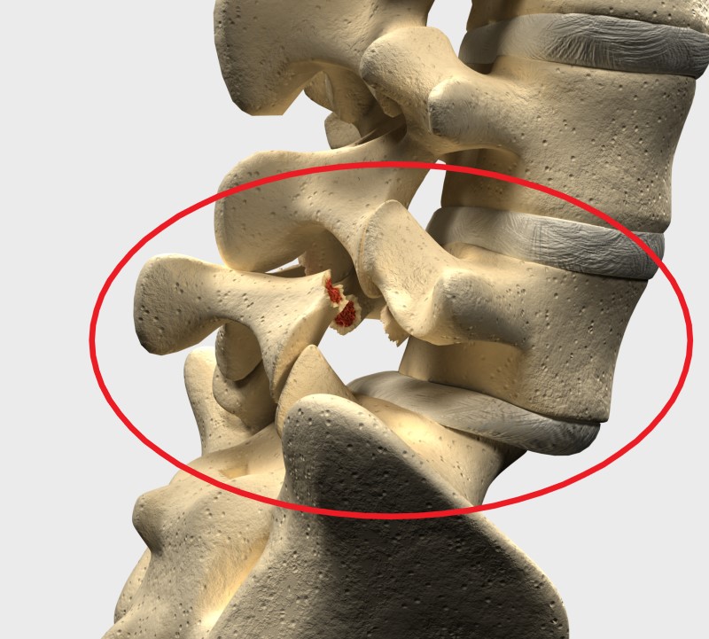 Espondilolistese na região lombar L5 e S1. Fonte da imagem: Getty Images Espondilolistese na região lombar L5 e S1 - modelo de esqueleto da coluna vertebral