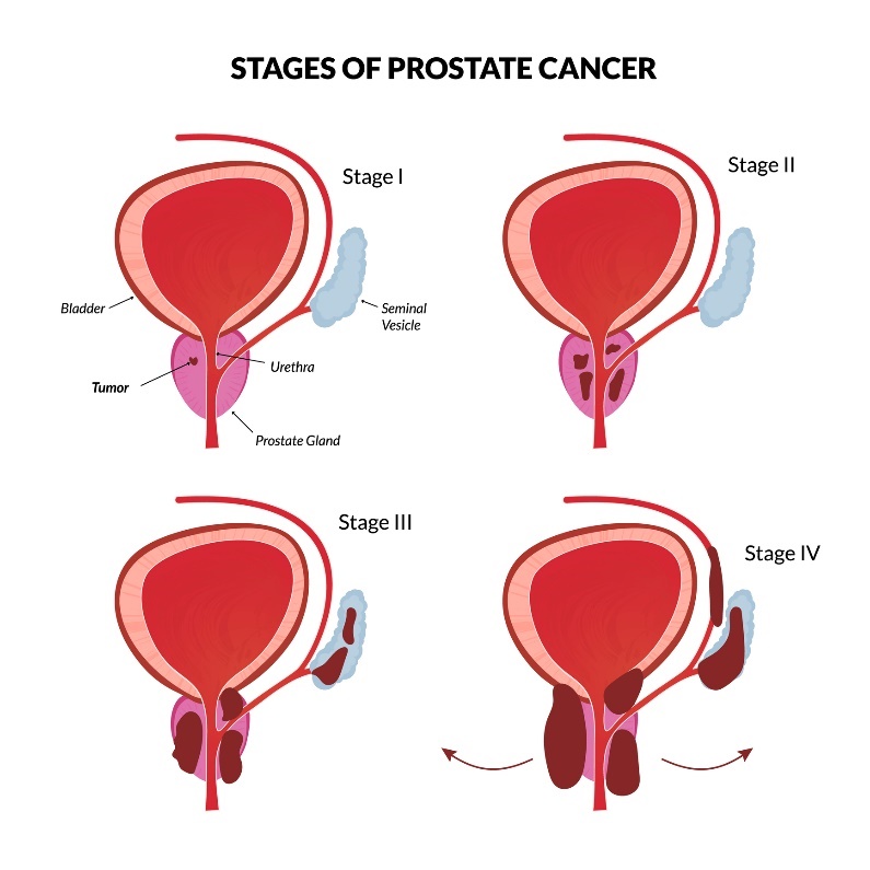 4 fases básicas do cancro da próstata. Fonte da foto: Getty Images 4 fases básicas do cancro da próstata