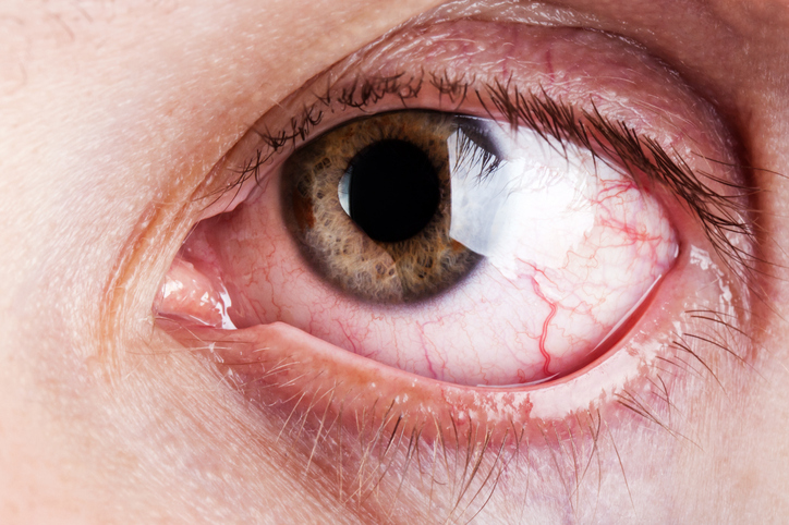 Olhos vermelhos e vermelhos e vasos sanguíneos em destaque. Foto: Thinkstock Olho vermelho no olho seco