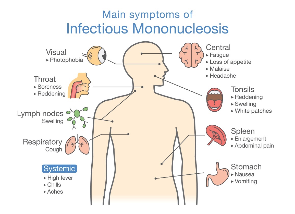 Sintomas da mononucleose infecciosa