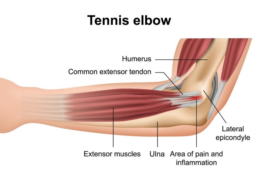 Cotovelo de tenista (epicondilite lateral): os ossos da articulação do cotovelo, os músculos extensores do antebraço, o epicôndilo lateral e o local da dor primária: Getty Images Cotovelo de tenista (epicondilite lateral): os ossos da articulação do cotovelo, os extensores dos músculos do antebraço, o epicôndilo lateral e o local da dor primária.