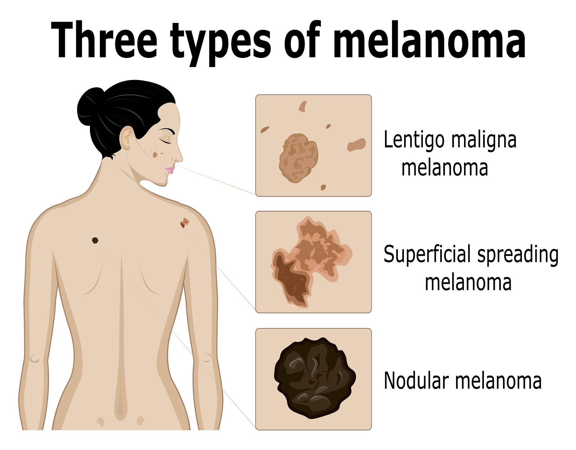 Uma representação dos três tipos de melanoma. Fonte: Getty Images Imagiologia dos três tipos de melanoma