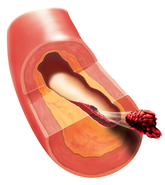 Coágulo de sangue deslocado - embolia. foto de origem: Getty Images Trombose num vaso sanguíneo, libertação de trombos, embolia, embolia por um coágulo sanguíneo