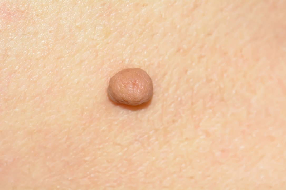 Fibroma de pele dura (fibroma durum) Fonte da fotografia: Getty Images Fibroma de pele dura (fibroma durum)