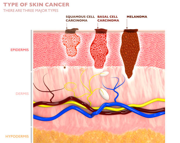 Tipos de tumores cutâneos, sua penetração na pele - carcinoma de células escamosas, basalioma e melanoma