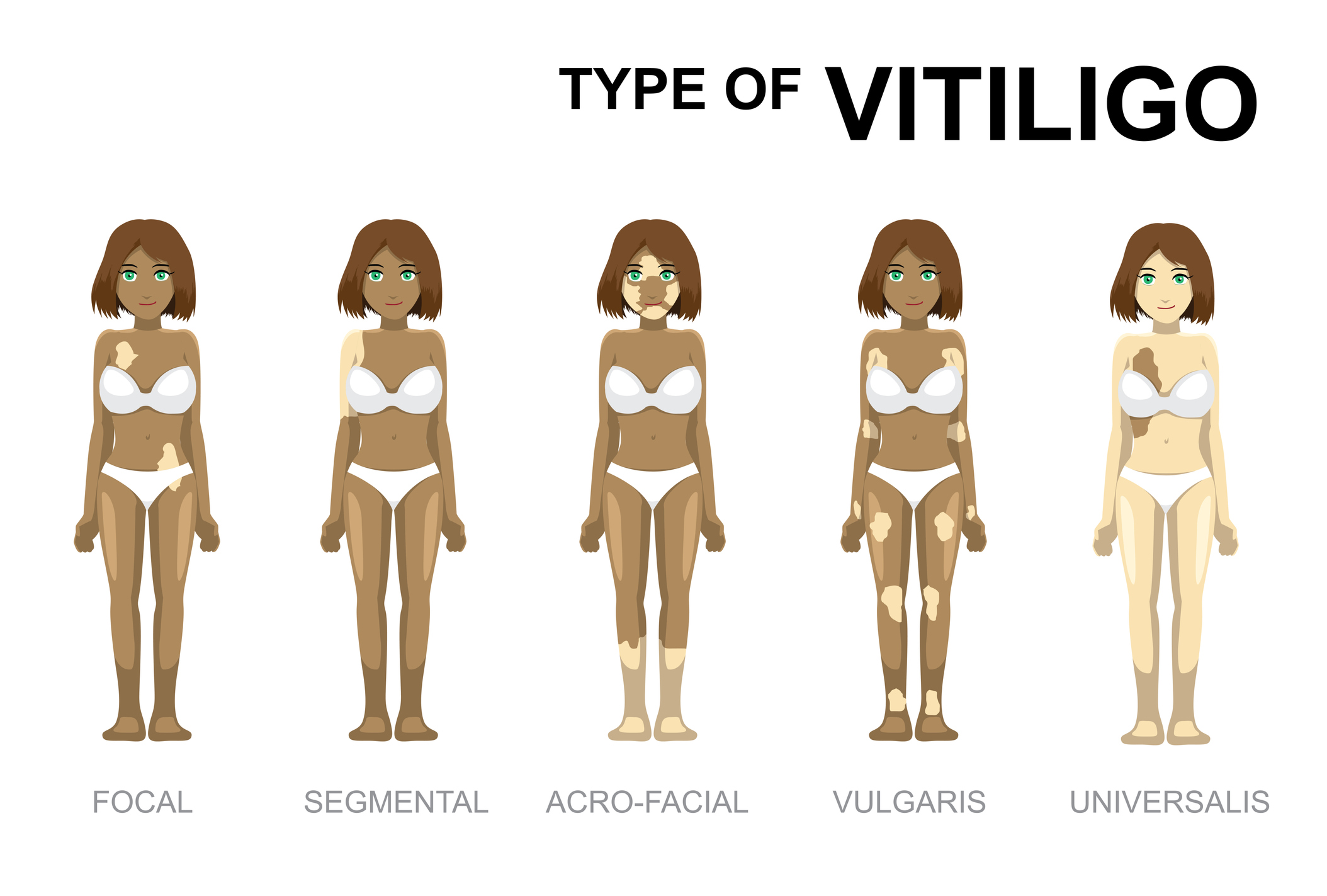 Tipos de vitiligo - focal / segmentar / acrofacial / vulgar / universal. Fonte Getty Images Tipos de vitiligo