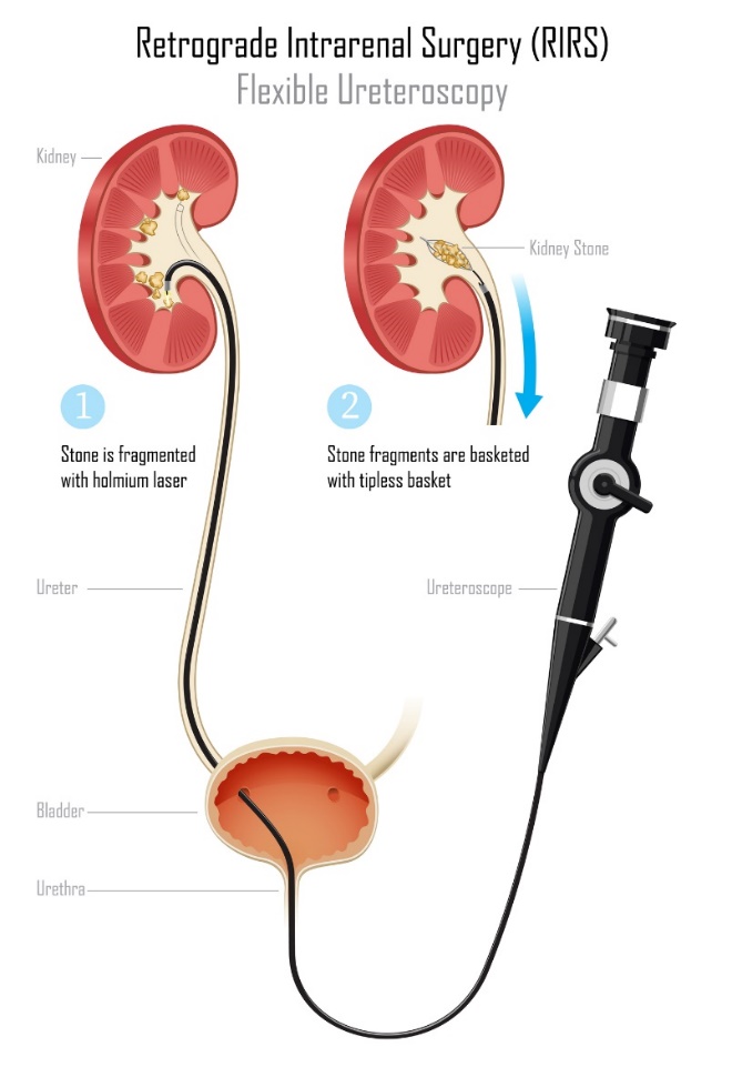Ureteroscopia: quebra e extracção de um cálculo renal utilizando um laser e um copo especial: Getty Images Ureteroscopia